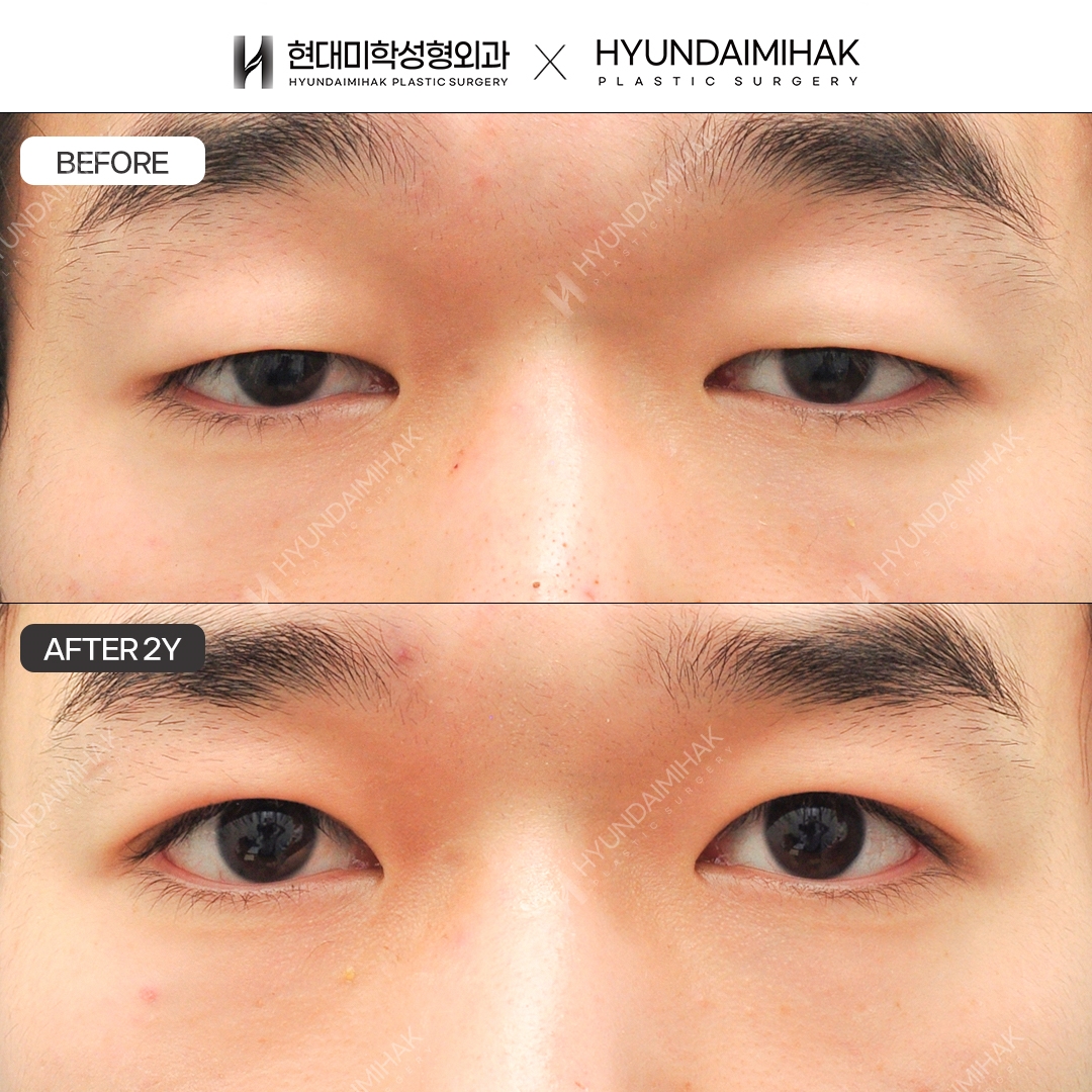 【男士眼部整形】非切开眼型矫正