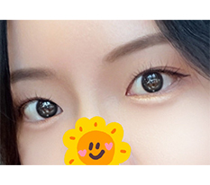 没有副作用的双重开眼角