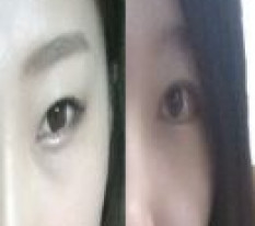 双重开眼角加埋线！变成漂亮眼睛啦~^0^