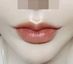 嘴角手术已经3个月了 ㅎㅎㅎ