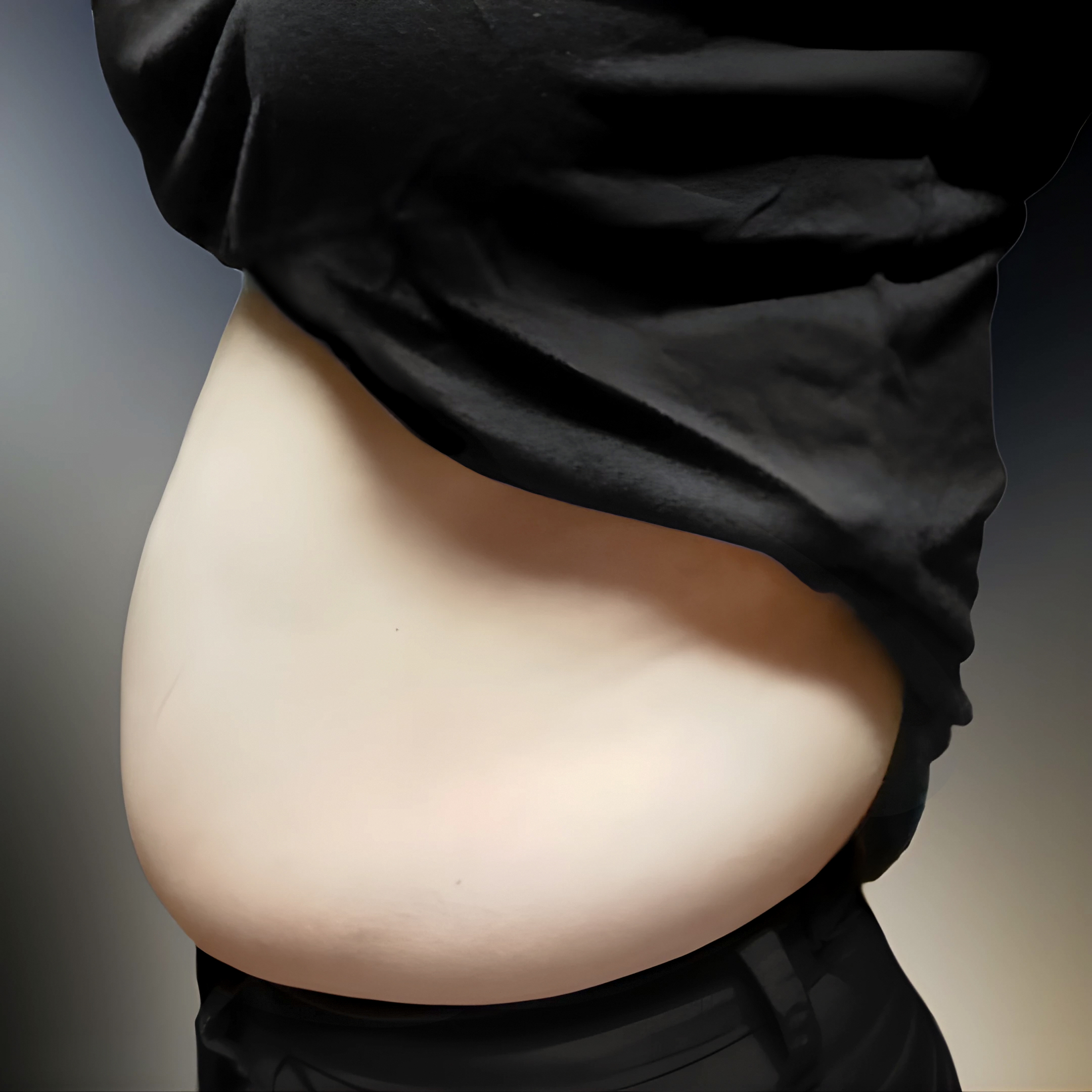 切掉腹部脂肪回来了 #lovehandles #侧腰 #后侧腰 #腹部