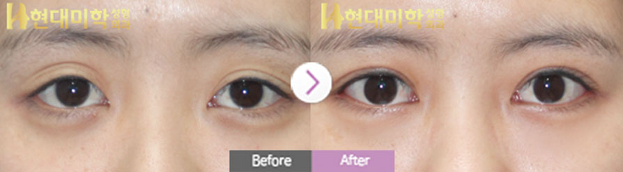 切开双眼皮修复、眼型矫正、开外眼角、下至术、上眼睑手术