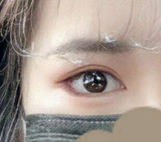 眼部修复手术效果不错吧??