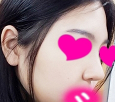 从南瓜鼻变成黄瓜鼻 lol