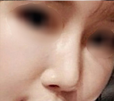 我在现代美学做了鼻修复，非常满意^^