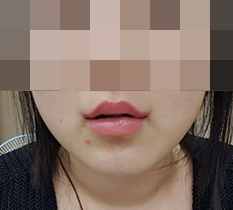 我做了嘴角整形~~