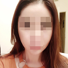 颧骨缩小太棒了ㅎㅎ