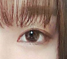 分享我亲自做双眼皮和开眼角的 体验 haha