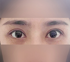 真的很庆幸在现代美学做了眼部修复ㅎ