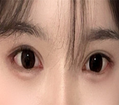 切开双眼皮+全开眼角，变成华丽眼