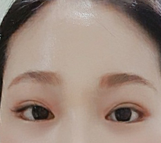 做额头提升后眼睛更清晰，很喜欢^^
