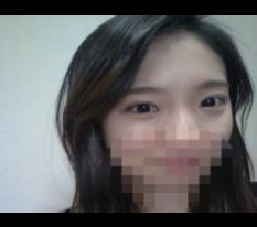 切开双眼皮和开眼角手术感想.. 现在才写哈哈