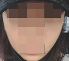 做了颧骨缩小后，整体印象完全不一样了♥