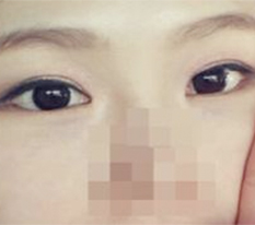 眼部整形满意后记^.^/
