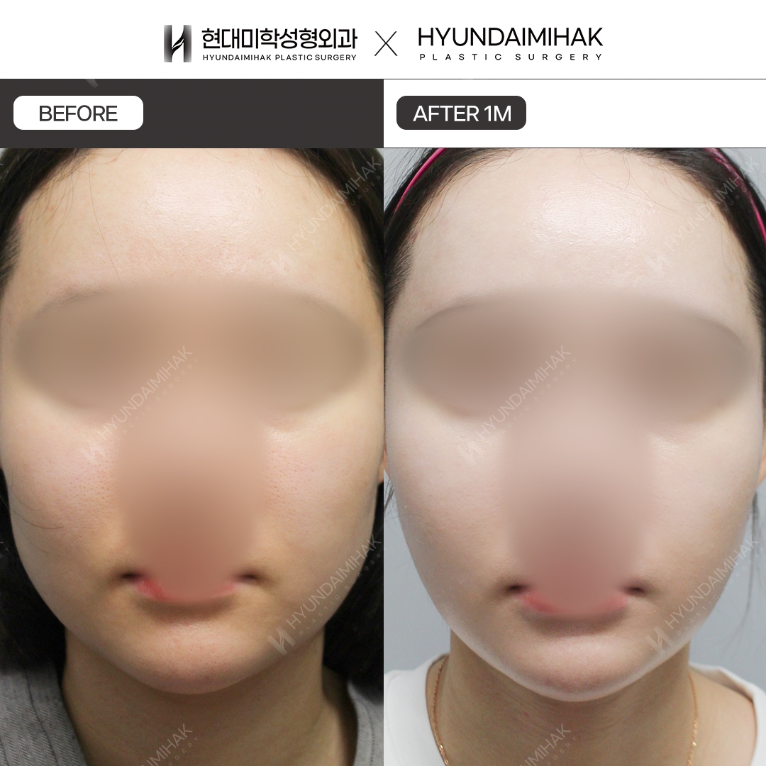 【提升】双下巴埋线提升术后1个月