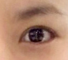 眼部修复一个月就有这种程度，感觉算成功了