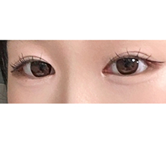 Both outer and lower canthoplasty succeeded!