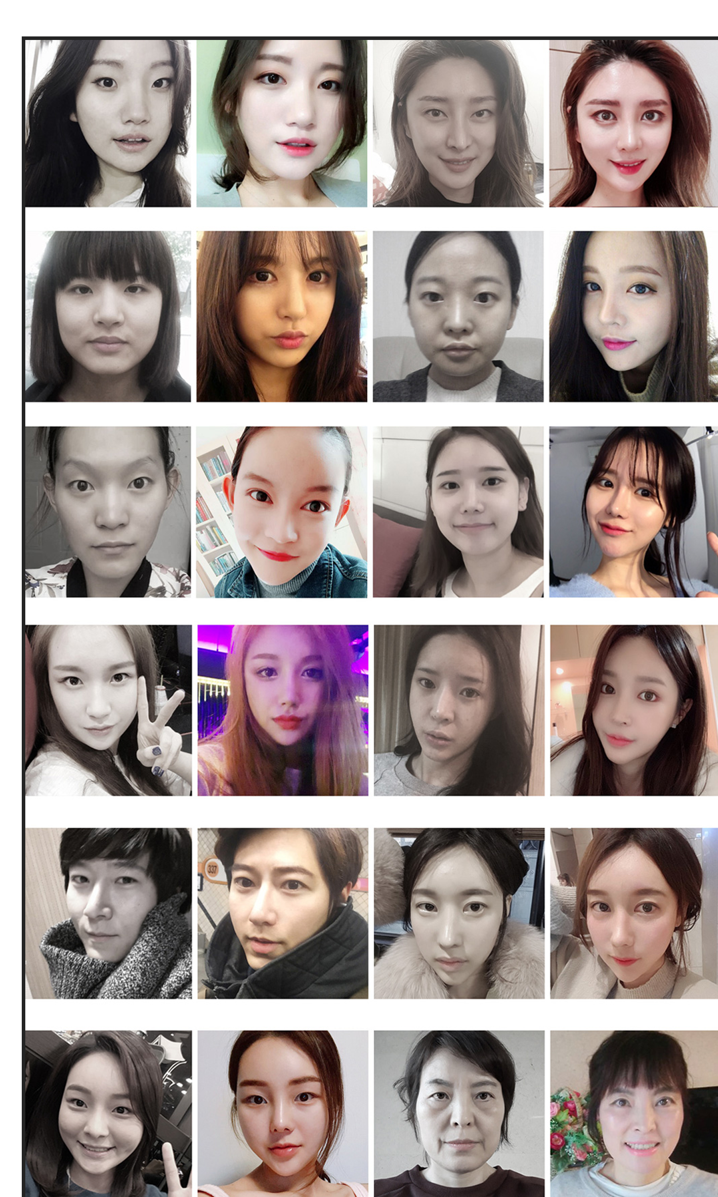 现代美学 开眼角修复手术 BEFORE & AFTER 案例