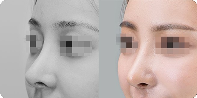 无假体鼻整形前后侧面比较 1 (BEFORE / AFTER 3MONTH)